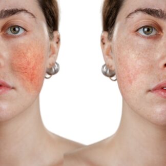 Проти почервонінь REDNESS CORRECT