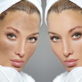 Відбілювання WHITENING